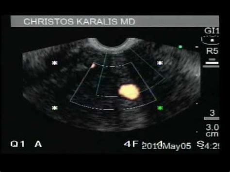 Arteriovenous Malformation (AVM) In Colon - Laserotherapy • Video ...