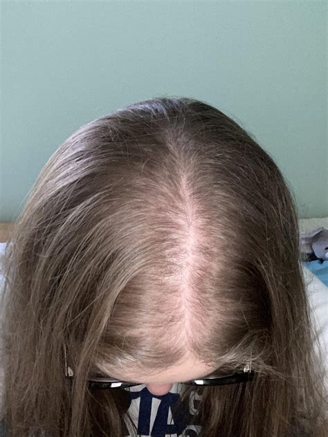 A Year On Minoxidil More In Comments R Femalehairloss