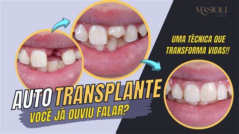 Autotransplante Dental Uma técnica que poucos conhecem e que pode