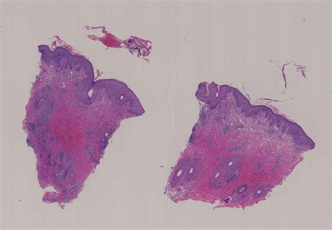 70s Male With A Scalp Lesion Rule Out Lymphoma Kiko Xp