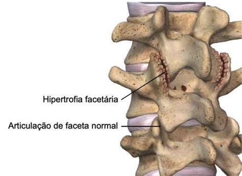 Artrose da Coluna Sintomas Diagnóstico e Tratamento Dr William Zarza