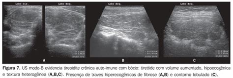 Radiologia Brasileira Import Ncia Da Ecogenicidade Da Tire Ide No