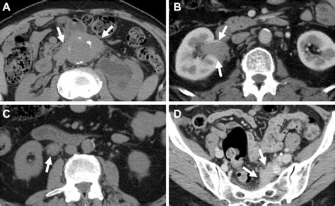 Typical Computed Tomography Findings In Idiopathic Rpf A Periaortic