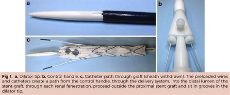 Figure 1 From Early Experience With A Modified Preloaded System For Fenestrated Endovascular