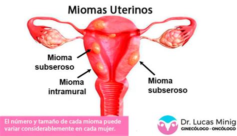 Miomas Uterinos Especialista en Valencia Síntomas Tratamientos