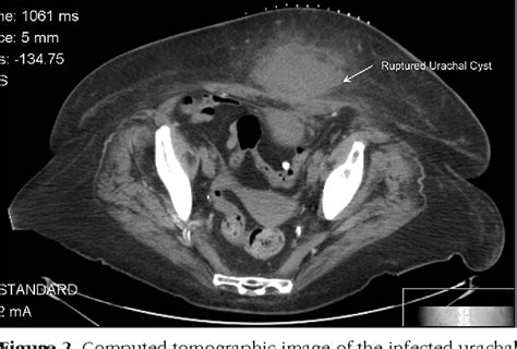 Figure 2 From Infected Urachal Cyst Following Laparoscopic