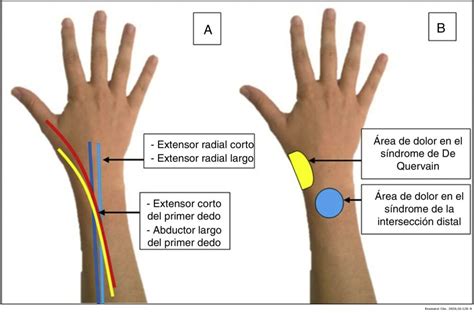 Tendinitis De Quervain Fisioterapia En Forma