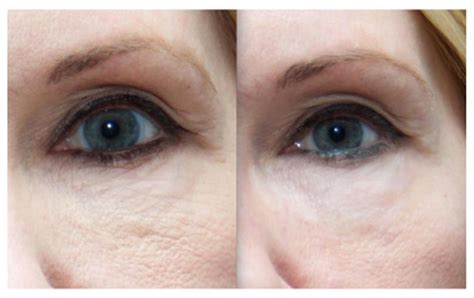 Unlocking The Benefits Of Microneedling For Your Eyelids Ecolumn