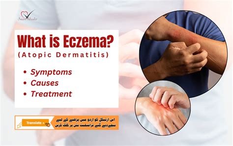 What Is Eczema? Meaning in Urdu, 6 Types, Causes, Symptoms, & Best ...