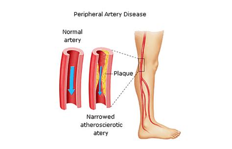 Peripheral Arterial Disease In People With Diabetes Dr Abhilash