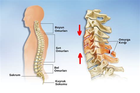 Omurga Kırıkları ve Omurga Kırığı Ameliyatı Turan Turan