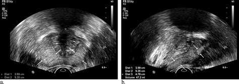 Prostate Biopsy For The Interventional Radiologist Journal Of Vascular And Interventional