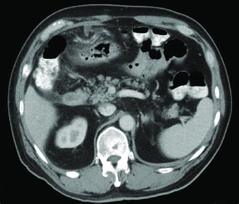 CT scan showing diminished size of the uncinate process lesion with no ...