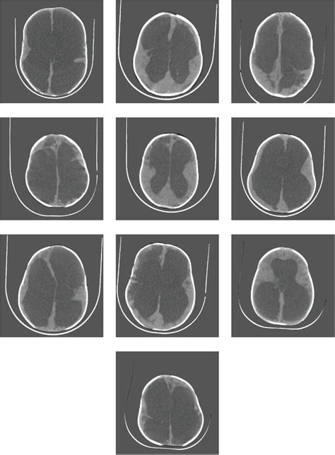 Hydranencephaly Mri