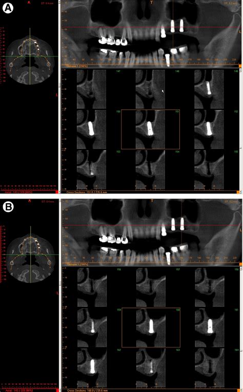 New Bone Formation In The Maxillary Sinus Using Peripheral Venous Blood