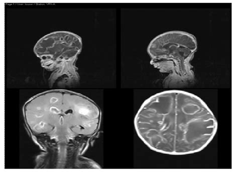 Mri Brain Showing Multiple Abscesses Download Scientific Diagram