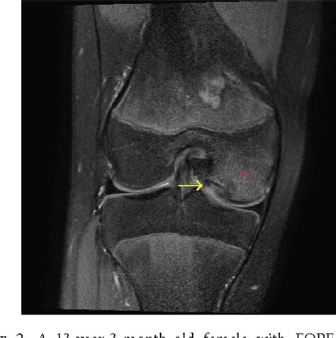 Figure 2 From Unusual Presentations Of Focal Periphyseal Edema Zones A