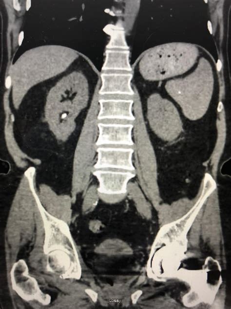 Kidney Stones – Modern Urology, Colorado