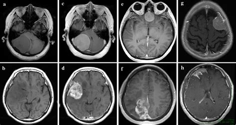 Prediction Of High Grade Meningioma By Preoperative Mri Assessment