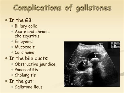 PPT - Gallstones: Anatomy, Types, Symptoms & Treatment PowerPoint