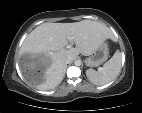 Radrounds Radiology Network On Twitter What Is The Diagnosis In This