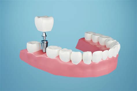 Are There Factors That Determine Which Type Of Dental Implant Procedure