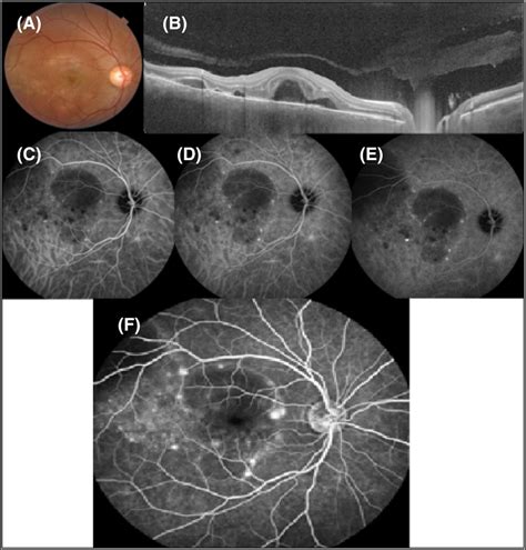 Multimodal Imaging Of The Re Multiple Foci Of Subretinal Fluids Srf