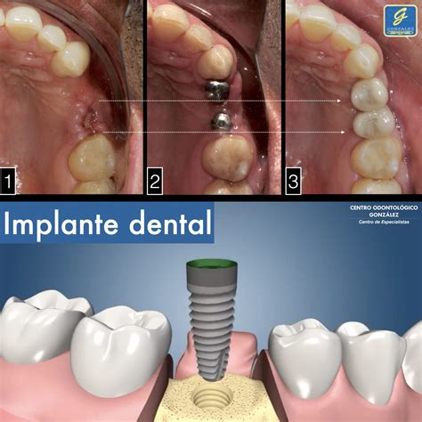 Implantes dentales en Cuenca Centro Odontológico González