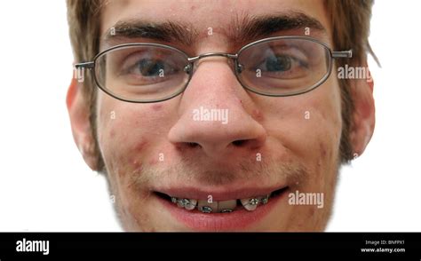 Man Showing His Braces Face Close Up Stock Photo Alamy