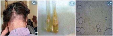 A Clinical Manifestation Of Tinea Capitis In A 75 Year Old Female