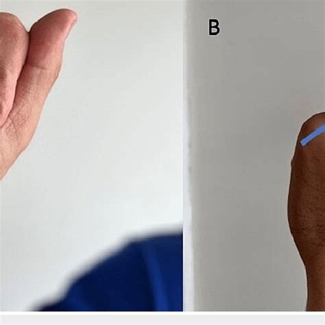 First carpometacarpal joint (A) Location of the first carpometacarpal... | Download Scientific ...