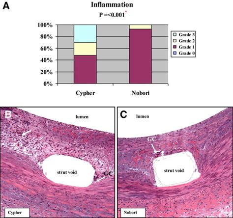 Nobori Stent Shows Less Vascular Inflammation And Early Recovery Of