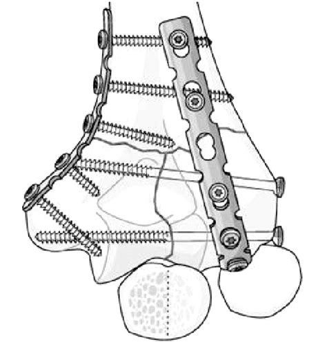 Conventional Orthogonal Plating With Congruent Elbow Plating System