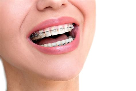 Clear Braces Vs. Metal Braces - Which One Is Right For You - Demotix.com