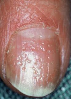 Nail pitting: Nail pitting causes