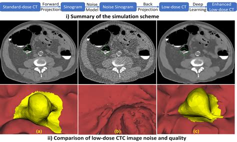 A patient with a 1.7 cm pedunculated polyp in the sigmoid colon. (a)... | Download Scientific ...