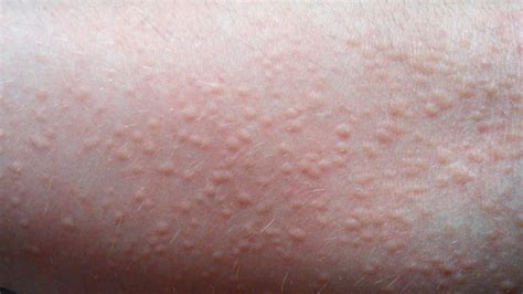 Itching Pictures Causes Diagnosis And Home Remedies