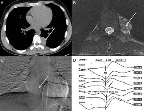 A Thoracic Ct Scan The Arrow Shows A Mediastinal Mass At The T8 T9 Download Scientific