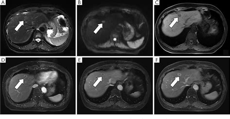 Figure 1 From Imaging Features Of Intrahepatic Bile Duct Adenoma In MRI