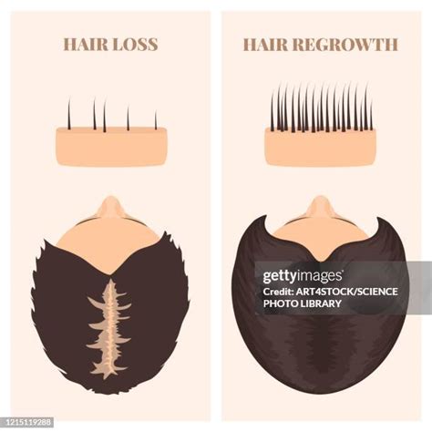 287 Hair Growth Before After Stock Photos, High-Res Pictures, and ...