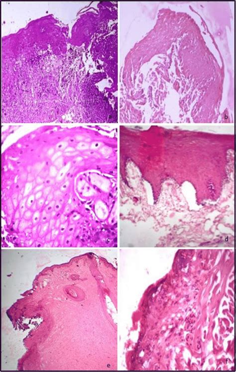 Histological Artifacts Epithelial Changes A Cleft B Erosion C