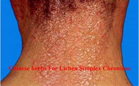 Using Chinese Herbs Treat Lichen Simplex Chronicus Lsc Tcm Houston