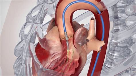 Valve Surgery For Copd Factors Affecting Recovery From Heart Valve