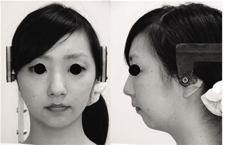 Posttreatment Frontal And Side View Facial Photographs Of Patient