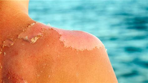 What Does Skin Cancer Really Look Like Cancer Sharecare