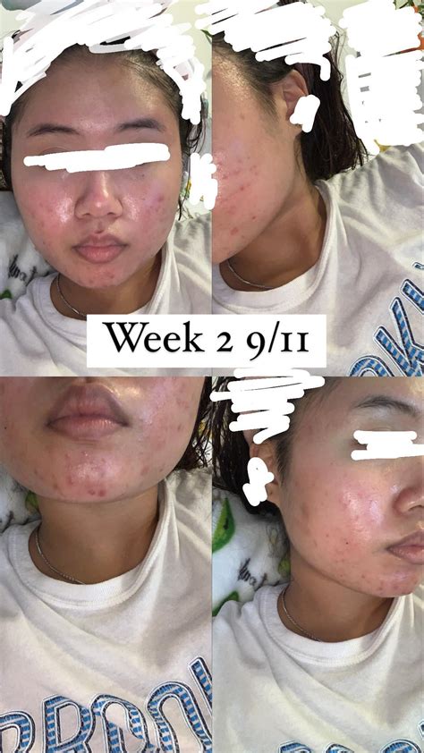 Do You See Improvement Started Tret 9 5 So Coming Up 8 Weeks Soon R Tretinoin