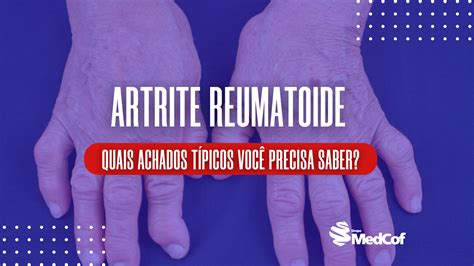 Artrite Reumatoide Achados típicos Blog Grupo MedCof