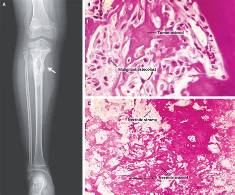 New Horizons In The Treatment Of Osteosarcoma Nejm