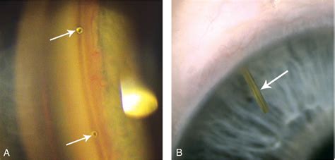 Glaucoma | Ento Key