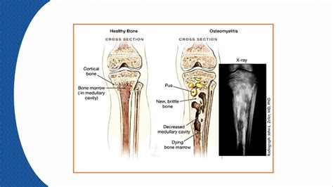 Osteomielite Dos Ossos Longos Youtube